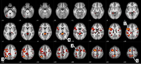 Ici, nous voyons les régions du cerveau qui montraient une différence statistiquement importante entre les patients atteints de schizophrénie et les patients qui ne le sont pas. Par exemple, la flèche 1 identifie la circonvolution frontale ascendante, ou le cortex moteur, et la flèche 5 indique le précuneus qui touche le traitement de l’information visuelle.