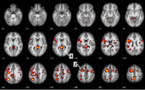 IBM et l’Université de l’Alberta publient de nouvelles données sur des algorithmes d’apprentissage automatique afin d’aider à prédire la schizophrénie